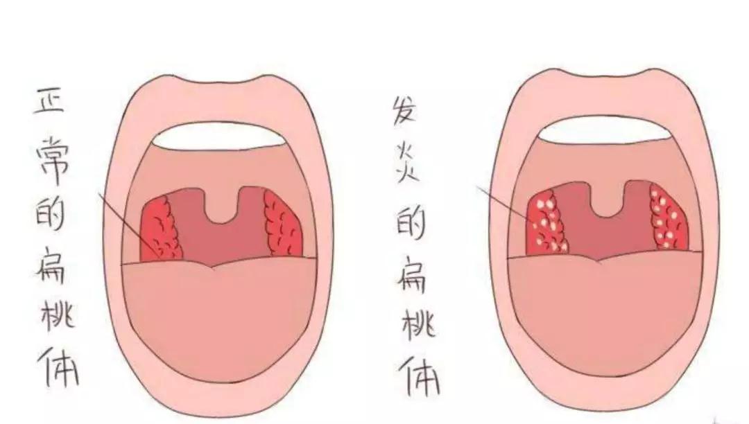 扁桃体炎的症状表现有哪些