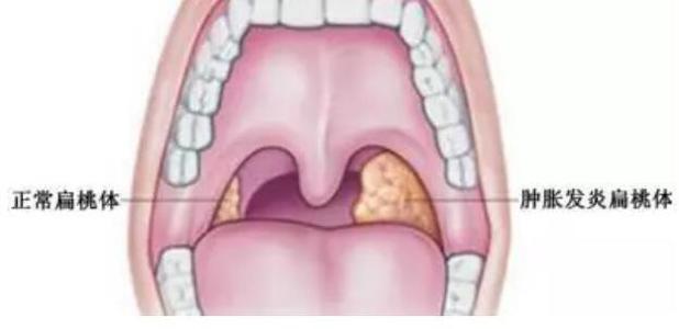 扁桃体炎的症状有哪些