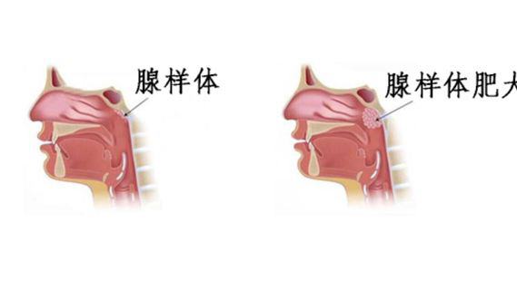 腺样体肥大的表现症状