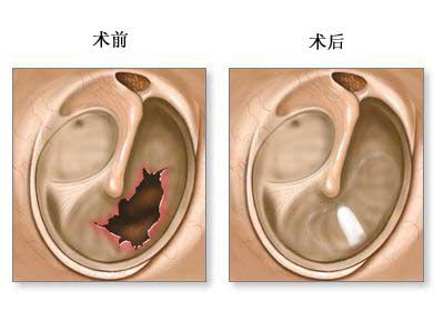 鼓膜外伤的危害