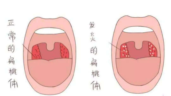 儿童腺样体肥大