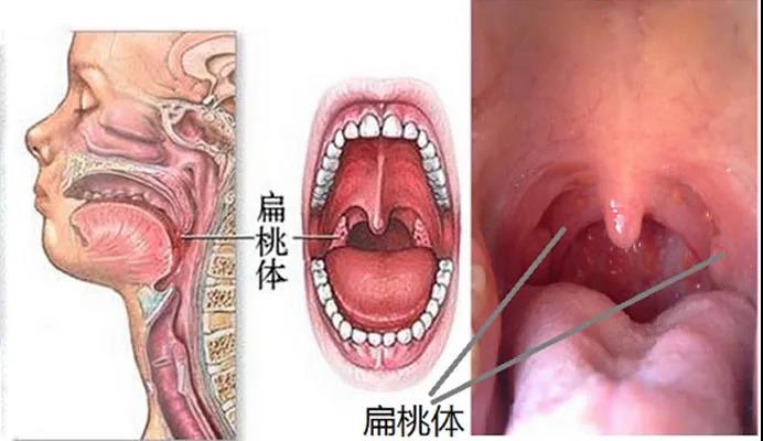 扁桃体炎