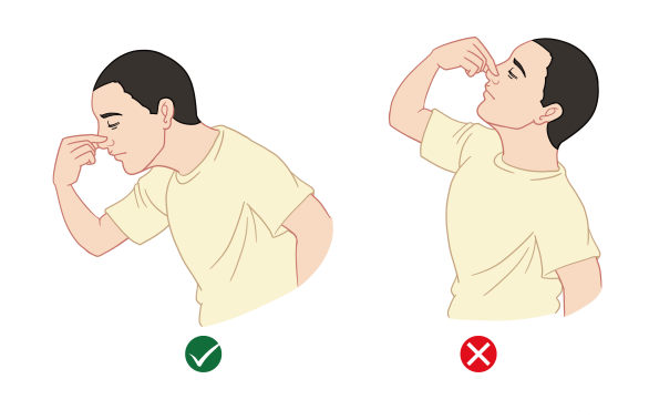鼻出血的处理方法