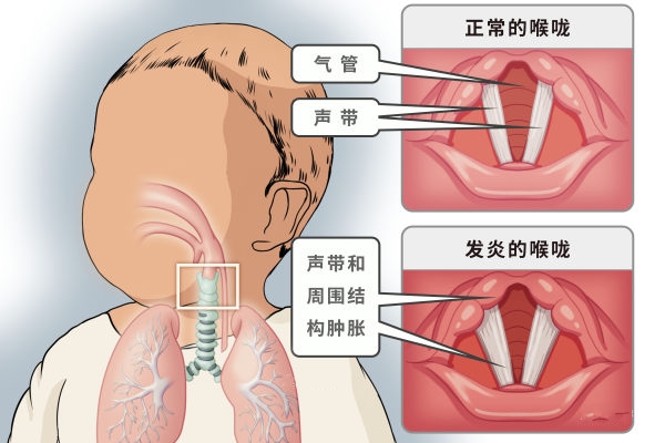 慢性喉炎