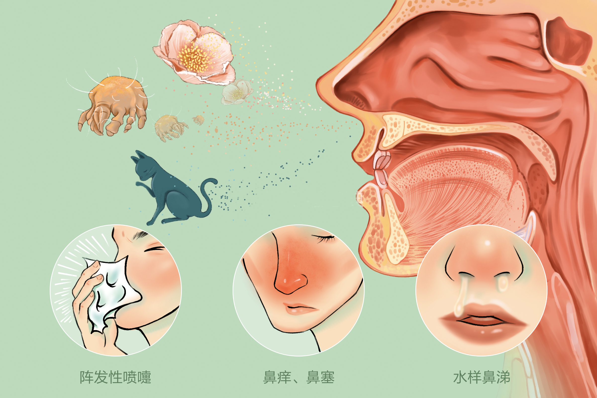 变应性鼻炎