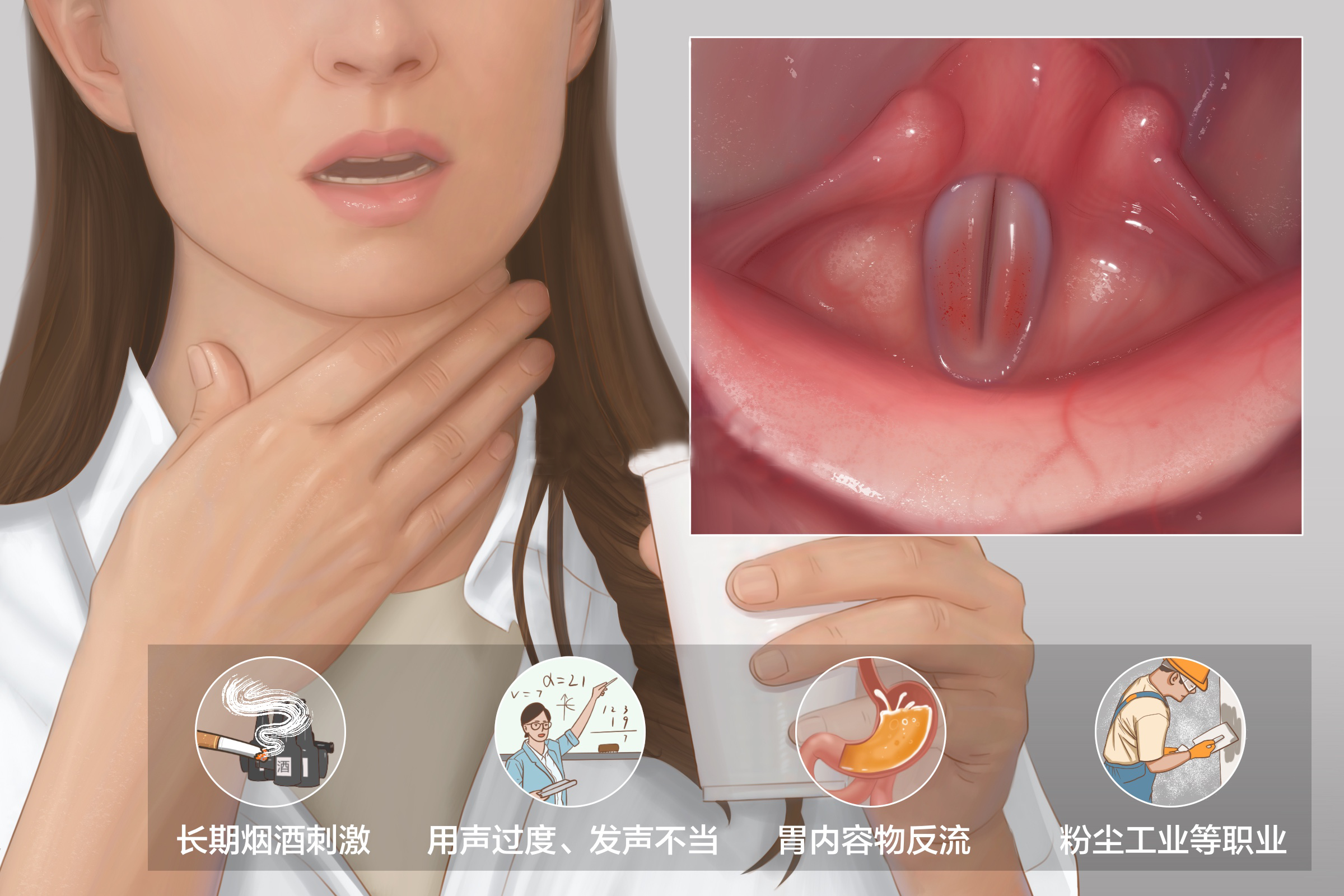 慢性喉炎